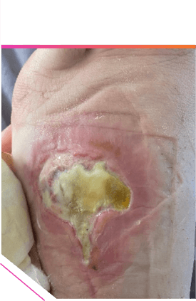 ABSSSI patient foot after 1 week course of treatment