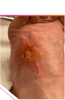 ABSSSI patient foot healed wound after 3 months